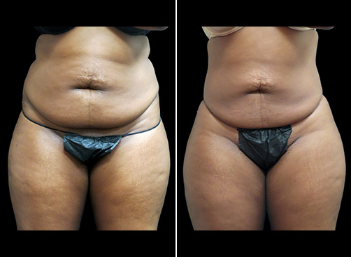 Patient #10965 Liposuction Abdomen Plus Size Before and After