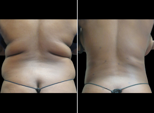Lipo For Women Before & After NYC