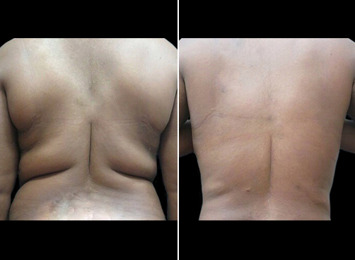 Back Liposuction - KleinLipo - Liposuction Surgery of Orange County