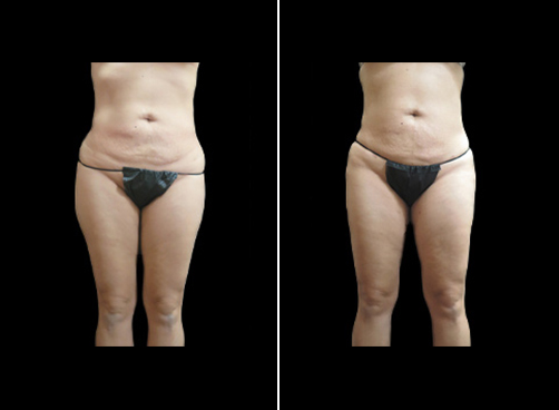 Liposuction of Flanks Before and After 3804