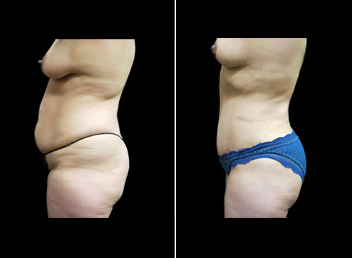 Liposuction Abdomen and Flanks Case 7001 - The Plastic Surgery Group