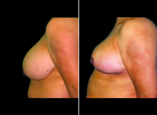 Liposuction And Breast Reduction Results