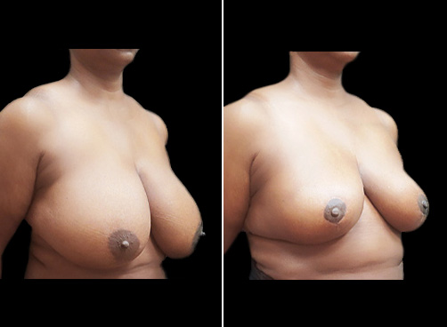 Before And After Lipo Surgery & Breast Reduction