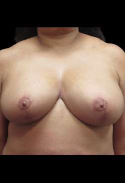 Liposuction and Breast Reduction Before & After Patient #719