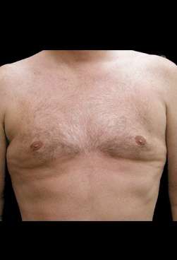 Liposuction and Gynecomastia Before & After Patient #775