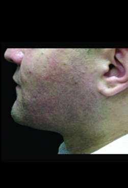 Laser Neck Lift and Submental Liposuction Before & After Patient #1318