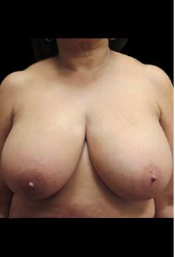 Liposuction and Breast Reduction Before & After Patient #719