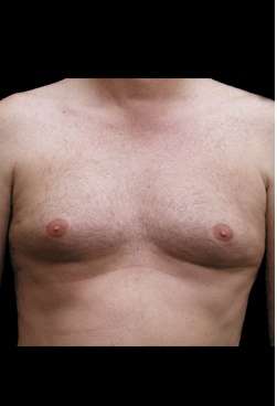 Liposuction and Gynecomastia Before & After Patient #775