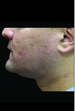 Laser Neck Lift and Submental Liposuction Before & After Patient #1318