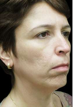 Laser Neck Lift and Submental Liposuction Before & After Patient #1321